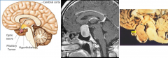  Mujer de 25
años de edad con síndrome de amenorrea y galactorrea de 4 meses de evolución.
Se muestra la MRI del cráneo y su comparativa anatómica.