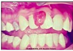localized, painless, protuberant, exophytic gingival mass that is attached by a sessile or pedunculated base from the gingival margin or more commonly from an interproximal space resulting from dental plaque and hormones during pregnancy.