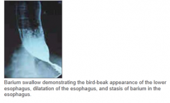 causes: failure of lower esophageal sphincter to relax, leading to dysphagia, regurgitation, chest pain & bird-beak appearance on radiograph

due to: absence of ganglion cells w/i wall of esophagus