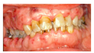 oral petechiae or bleeding, mucosal ulceration, and gingival enlargement