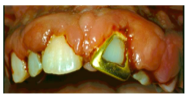 swollen, glazed and spongy tissues
red or purple-red in color
gingival bleeding.
Gingival enlargement begins at the interdental papilla followed by marginal and attached gingiva.
Enlargement does not go away despite good OH, scaling and root p...