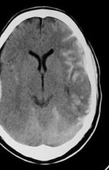 Subarachnoid bleeding in trauma is almost always insignificant, seen on the surface of the hemispheres in relation to fracture sites or contusions. Occasionally, if a vessel at the base of the brain is damaged, a large amount of blood collects in ...