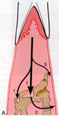interproximally from gingiva into the bone(1) from bone into PDL (2), and gingiva into PDL (3)