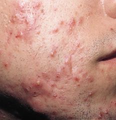 Condition?
Infection of?
Caused by? (4 factors)
Prevalence?
Tx?