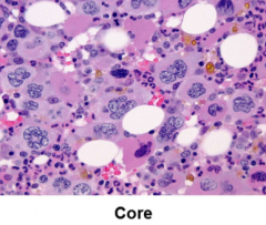 What is your interpretation of this bone marrow?

what would your causes be?