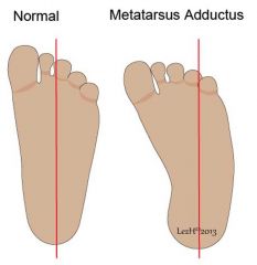most common in firstborn

tx = serial plaster casts before 8mo, orthoses, corrective shoes