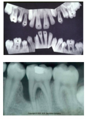 1)Vertical loss of bone around first molars and incisors beginning around puberty in otherwise healthy teenagers 
2) Also an arc shaped loss of bone extending from the distal surface of second premolar to medial surface of second molar (NIKE chec...