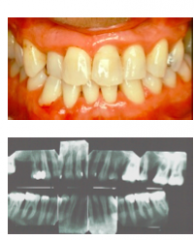 Generalized inter-proximal attachment loss affecting at least THREE permanent teeth other than first molars and incisors