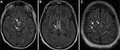 Abnormal signal on MRI:
1. Medial thalami
2. Mamillary bodies (part of the hypothalamus, can enhance)
3. Periaqueductal region

Thiamine before glucose:
Glucose is metabolized to pyruvate. Pyruvate can be metabolized to lactic acid (can be lethal...