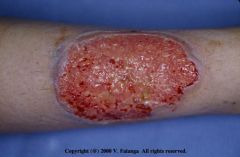 rapidly enlarging, very painful ulcer, with tender red/blue overhanging necrotic edge
