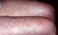 mottled discoloration of skin
- disturbance of blood flow to the skin causing low blood flow and reduced oxygen tension to the skin