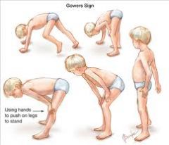 1. muscle weakness that is progressive, symmetric and starts in childhood. Proximal muscles primarily affected (pelvic girdle). Eventually involves the respiratory muscles
2. Gower's maneuver- patient uses hands to get up from the floor because t...