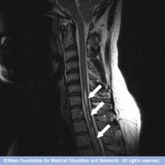 1. central cavitation of the cervical cord to abnormal collection of fluid within the spinal cord parenchyma
2. most commonly associated with Arnold-Chiari malformation. Other causes are post-traumatic, postinfectious, tethered cord and intramedu...
