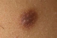o   Button like dermal nodule usually
solitary lesion on lower legs 
 o   Usually will dimple sign
