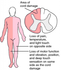 1. spinal cord hemisection (i.e. lesions involving either the right or left half of the spinal cord (usually at teh cervical levels (where spinal cord enlarges)
2. causes include trauma (fracture or stab wound), that causes hemisection of the spi...