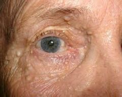o   Benign tumors of eccrine glands, most
commonly located around eyes
