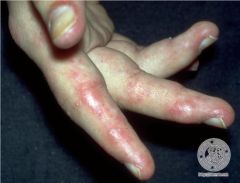 red, violaceous papules and plaques located on acral areas
- cold, moist precipitate 
- mild pain, pruritus and/or hyperhidrosis