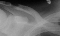 Outer 1cmof clavicle 
Prox humerus
Pubic symphysis 
SIJ 
Salt + Pepper Skull
Radial sided Phalangeal Erosions
Codfish Vertebrae: Biconcave vertebraedue to compression #s      

Chondrocalcinosis