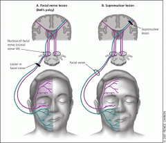 History:
I. OTOLOGICS SYMPTOMS (Hearing loss, Tinnitus, Vertigo, Ear Discharge) 
II. NEUROLOGIC SYMPTOMS 
III. TRAUMA 
IV. RECURRENCE 
V. TICK BITES (borreliosis) 

Physical examination: 
When a patient presents with facial weakness, differe...