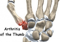 What joint is this arthritis occurring at? 