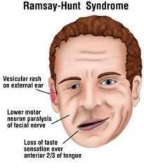 The Ramsay–Hunt syndrome, caused by reactivation of the varicella-zoster virus (VZV) within the geniculate ganglion, is the second most common cause of atraumatic facial palsy. 

Clinically, it is characterized by the triad of: 
- acute facial...