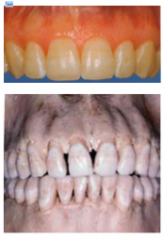 High scalloped gingival tissue 
Delicate and friable thin tissue 
Teeth triangular in shape 
Underlying osseous form scalloped, dehiscence and fenestration 
Minimum zones of keratinized gingiva 
Contact areas of adjacent teeth located towards...