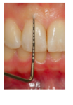 Thinner labial bone plate 
Narrower keratinized tissue width
greater distance from CEJ to initial of alveolar crest 
Probe visibility through sulcus