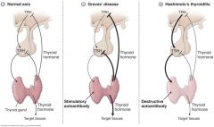normal axis, graves disease (stimulatory autoantibody) and hashimoto's thyroiditis (Destructive autoantibody)
