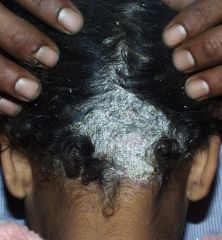 occurs on head, scalp.

associated lymphadenopathy, alopcia, scaling (Schuppung)