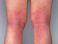 Dry, scaling, and red lesions are typically on the flexural surfaces such as the antecubital or popliteal fossa