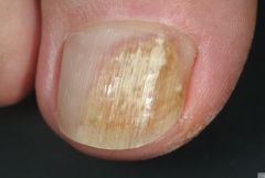 Onychomycosis

occurs on nails