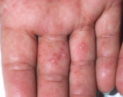 - Seen on the hands and/or feet


- Tapioca-like vesicles occur between the fingers or toes along with scaling


- Scaling inflamed skin can proceed to develop painful cracks and fissures
