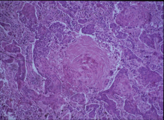 What is the circular structure in the middle?
Where is the neoplasia?
What is the diagnosis?
What is the most common lung cancer type to cause hypercalcemia?