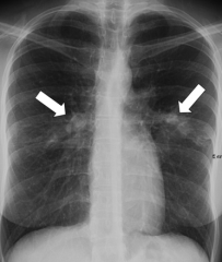 caused by aspergillus fumigatus

hypersensitivity response associated with asthma and cystic fibrosis

may cause bronchiectasis and eosinophilia