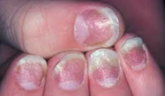 - Pitting


- Onycholysis (detachment from nail bed)


- Subungual keratosis
