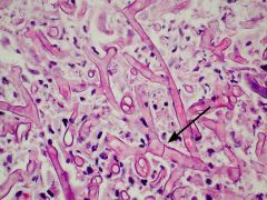 irregular, broad, nonseptated hyphae branching at wide angles

Mucormycosis

Causes:
disease mostly in ketoacidic diabetic and neutropnic patients (eg leukemia)

fungi proliferate in blood vessel endothelium --> penetrate cibriform plate --> ente...