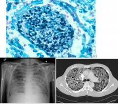 yeast like fungus, inhaled
most infections are asympomatic

causes: 

Pneumocystis pneumonia (PCP) often in AIDS
--> diffuse interstitial pneumonia
-->diffuse bilateral ground glass opacities on CXR/CT
-->diagnosed by biopsie or lavage
-->disc sh...