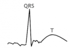 Does this ECG seem to indicate atrial fibrillation?
(Yes - No)