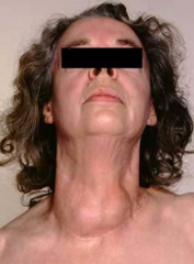 










Mujer
de 36 años de edad con datos clínicos de hipertiroidismo, aumento de volumen en la parte
anterior del cuello. Se extirpa la glándula tiroides 