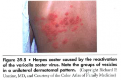 Prolonged and painful after effect of HSV or VZV


- Presents as chronic pain in the dermatome previously infected with herpes zoster