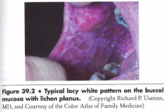 - Psoriasis


- Lichen planus (picture)


- Trauma