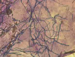 Treat a skin scraping with KOH and analyze under a microscope for classic hyphae or yeast forms (77-88% sensitive, 62-95% specific)


 


Or a fungal stain (Swartz-Lambkins) will make hyphae stand out from epithelial cells


 


Fungal c...