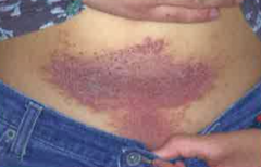 - Allergic response to an allergen such as the chemical found in poison ivy or poison oak plant (rhus dermatitis)


- Often linear and vesicular lesions