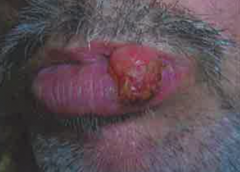 - Irregularly shaped plaques or nodules with raised borders


- Frequently scaly, ulcerated, and bleed easily