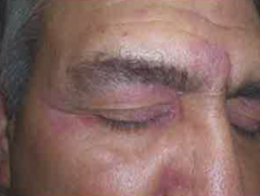 Superficial inflammatory dermatitis - characterized by erythema and scaling on the scalp (dandruff) and face (eyebrows, eyelids, nasolabial creases, behind the ears, forehead, cheeks, around the nose, under beard/mustache); also may be over sternu...