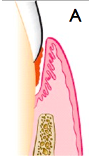 When the base of the pocket is coronal to the underlying alveolar bone 
One of the hints if you can see if you have same bone level. The mesisal of one tooth and distal of adjacent tooth should have same numbers. If you have disrepancy you need t...