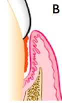The bottom of the pocket is apical to the level of the adjacent alveolar bone. 
The lateral pocket wall lies between tooth surface and alveolar bone. 
Presents as a vertical defect