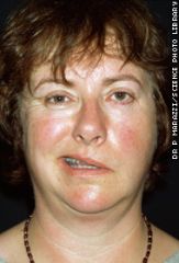 - acute onset of unilateral facial weakness/paralysis. Both upper and lower parts of the face are affected
