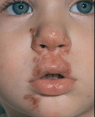 What's on this child's face?