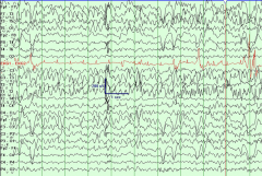 a. rhythmic theta discharges in one temporal regions


Complex partial seizures occur in children and adults with certain forms of epilepsy. They are the most common type of seizure in adults.

    An aura may occur at the beginning of a seiz...